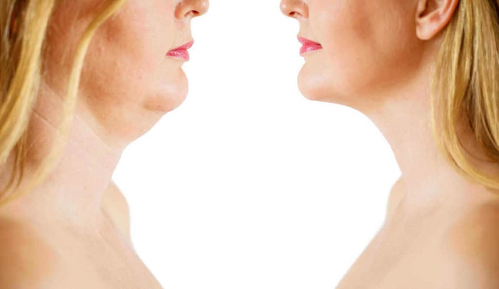 Double Chin treatment Gloucestershire before and after results