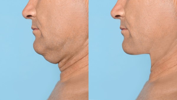 Which Non-Surgical Treatments Work Best for Jowls and Loose Skin Gloucestershire?