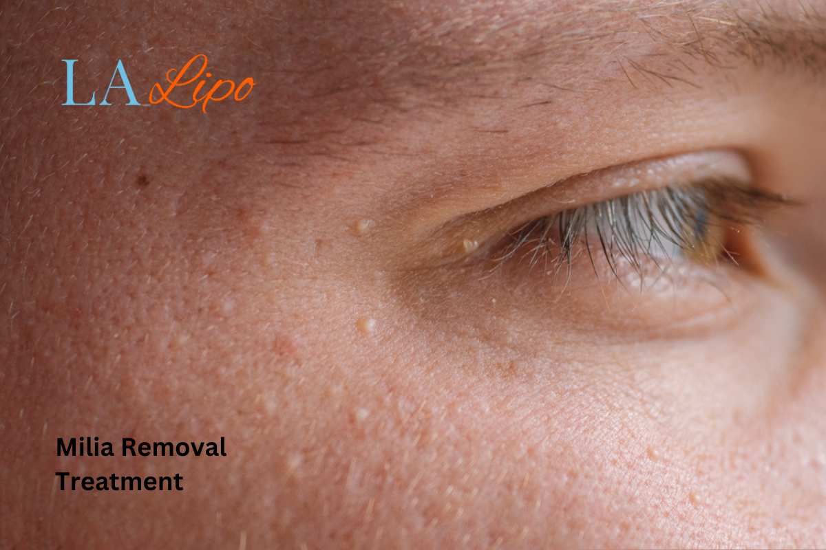 Cryopen Milia Removal: Is It the Easiest and Safest Option Gloucestershire?