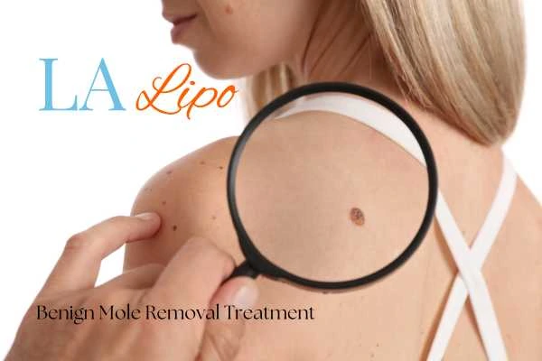 Woman having her inspection of blemish before mole removal Gloucestershire
