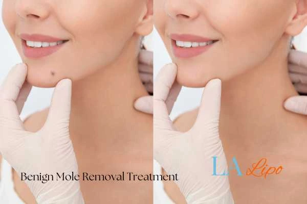 Before and after mole removal Gloucestershire treatment