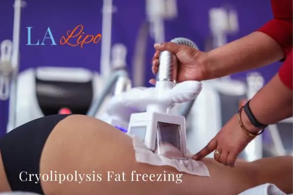 women getting fat freezing Gloucestershire