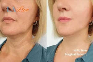 hi-fu for wrinkles Gloucestershire before and after results