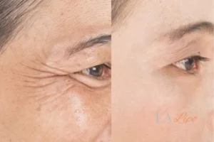 Before and after results of woman - HI-fu wrinkles reduction treatment Gloucestershire