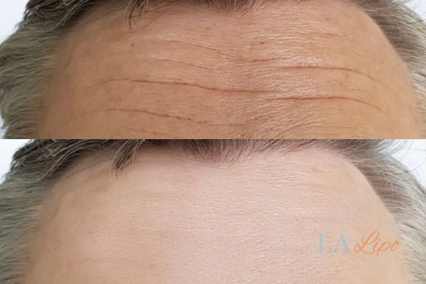 results of HIFU Gloucestershire on mans forehead to help reduce lines and wrinkles