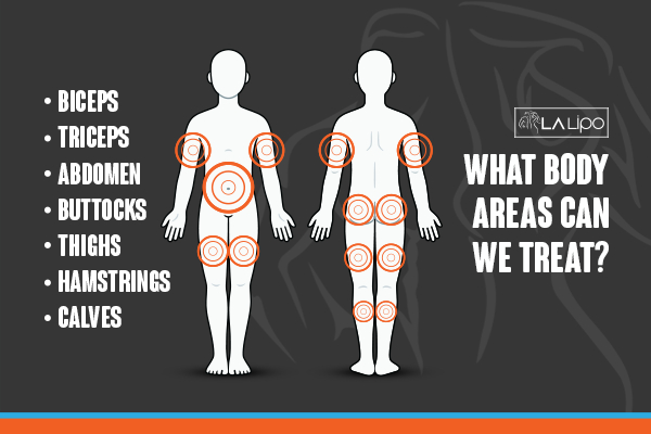 Graphic to show areas you can have LA-EMS Body Sculpting Gloucestershire treatment.