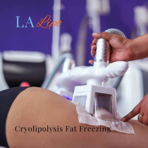 fat freezing - Cryolipolysis Gloucestershire