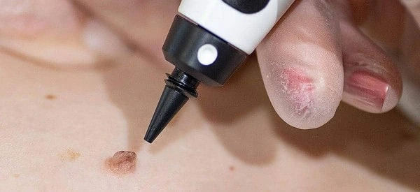 skin tag removal using cryopen Gloucestershire