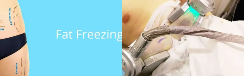 multi areas of a persons body having coolsculpting Gloucestershire treatment