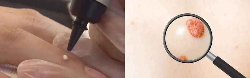 Cryopen for mole removal Gloucestershire - speak to our team today!