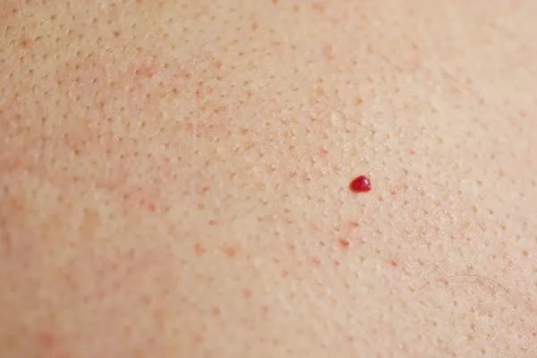 close up of a cherry angioma Gloucestershire