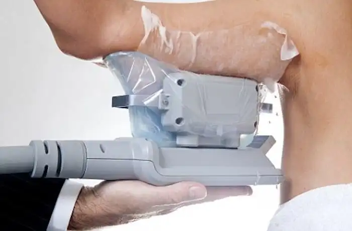 Picture of fat freezing Gloucestershire on the upper arms.