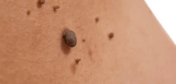image of a skin tag Gloucestershire