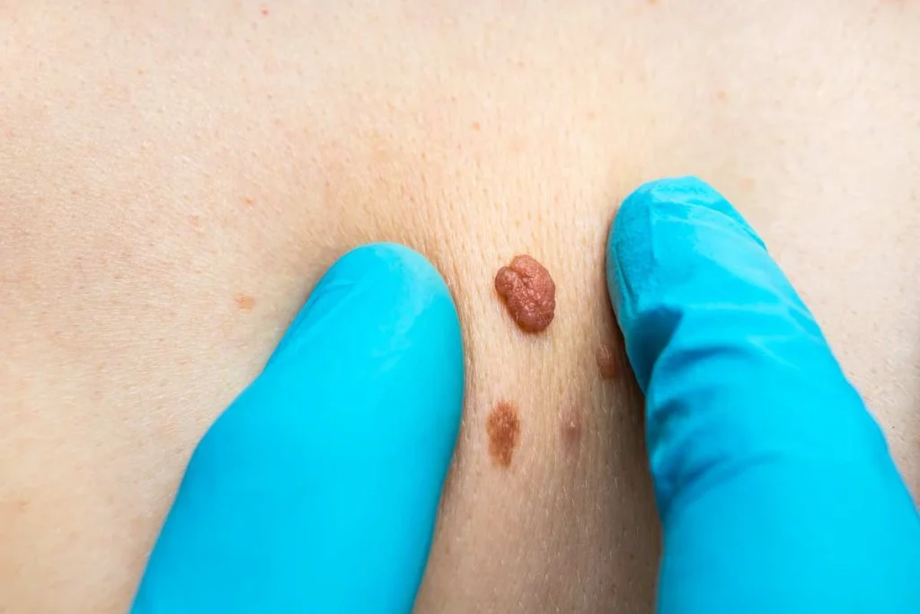 Consultant examining a skin tag Gloucestershire