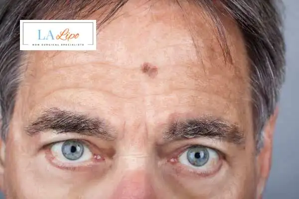 Solar Lentigo Removal Gloucestershire image of man with mark on his forehead
