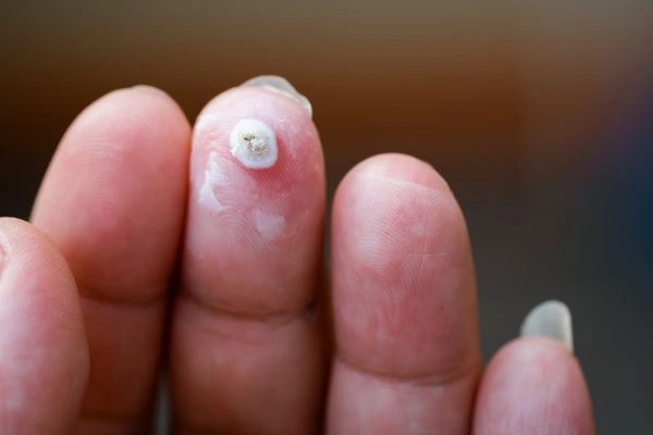 wart on person finger - cryotherapy to treat from LA LIPO Gloucestershire