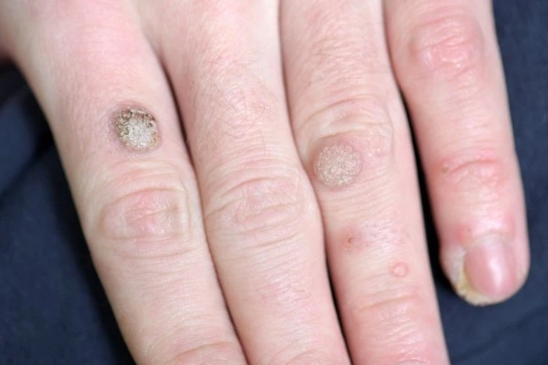 photo of warts on person hand - see wart removal Gloucestershire from LA LIPO