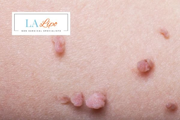 Does cryopen skin tag removal Gloucestershire hurt? Find out now call our team today!