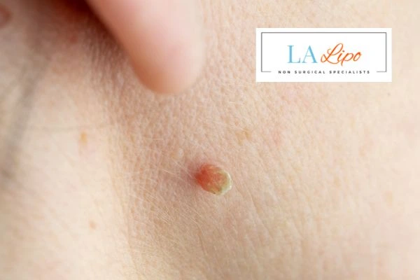 Book skin tag removal Gloucestershire today speak to our team now!