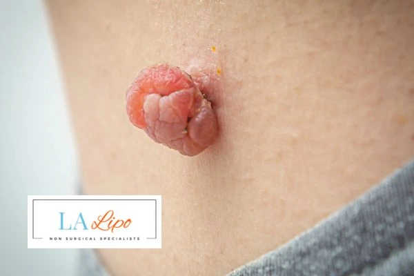 Interested in skin tag removal Gloucestershire? Concerned about the pain? Find out more today!