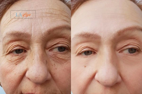 The powerful benefits of Morpheus8 Treatment Gloucestershire - Call Our team today!