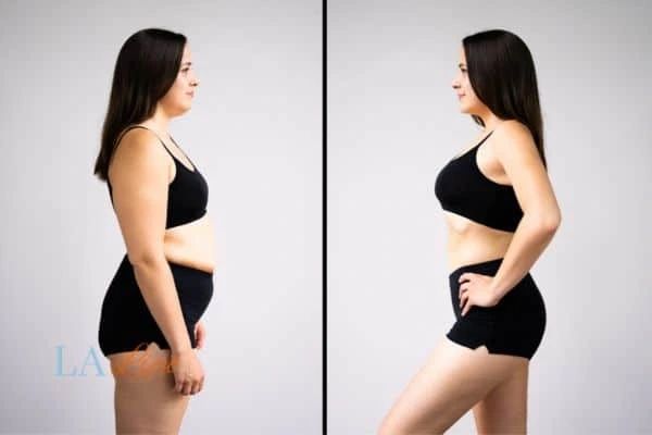 Picture of womans before and after using LA-EMS body sculpting to improve her core strength Gloucestershire