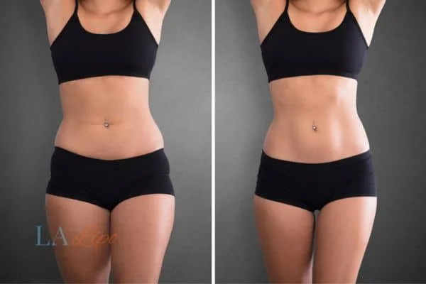 before and after results of non-surgical treatment to help a woman's body image and mental health Gloucestershire
