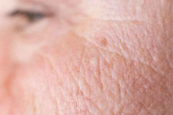 close up picture of a woman's face showing an age spot Gloucestershire