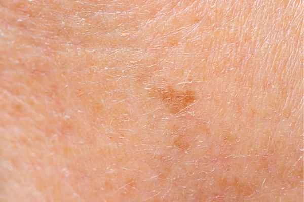close up picture of age spots Gloucestershire