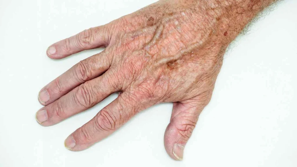 Male hand showing age spot Gloucestershire