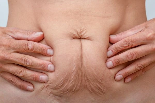Image of a woman's stomach with loose skin - example of skin tightening Gloucestershire options