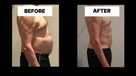 What Symptoms Can Diastasis Recti Cause in Men? Weak Core, Back Pain and Poor Posture Gloucestershire